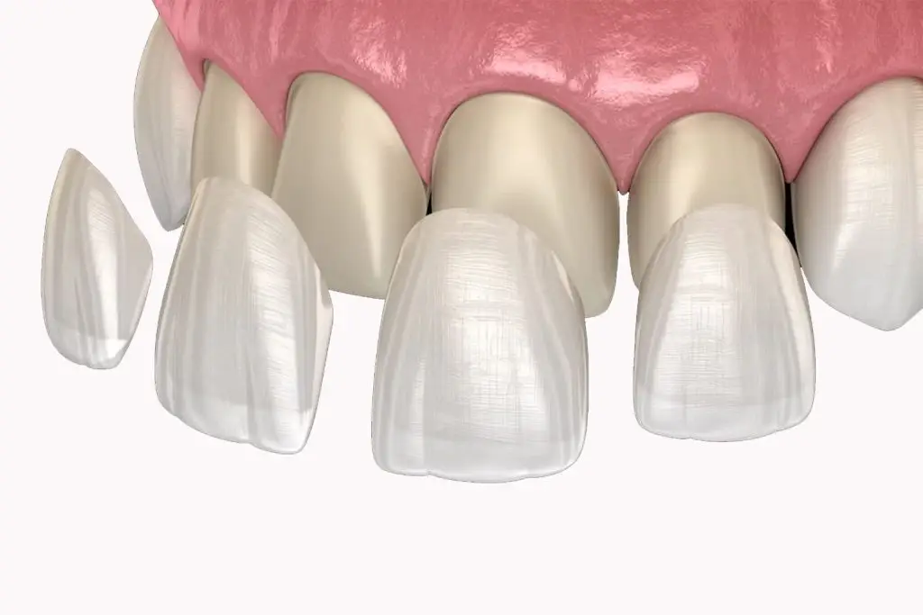 carillas de silicato de litio